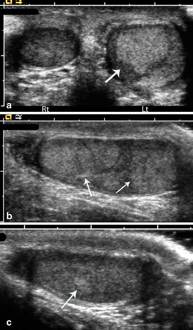 Mccune Albright Syndrome Presenting With Unilateral Macroorchidism And