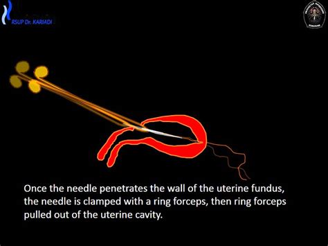 Hang Up Iuds New Technique Immediate Postplacental Iud Insertion