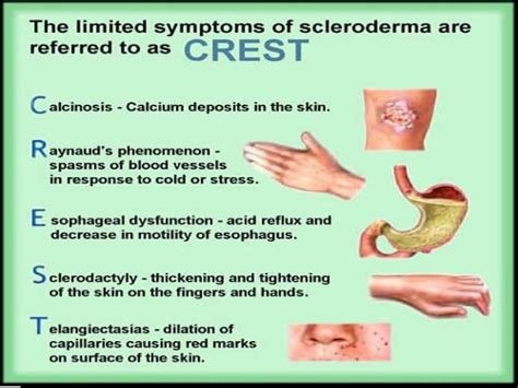 Scleroderma