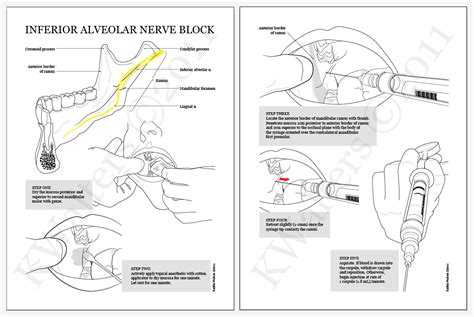 Inferior Alveolar Nerve Block Landmarks