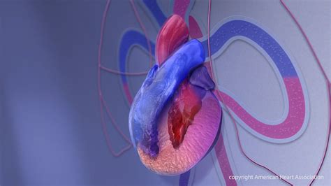 Mavacamten Could Treat Underlying Causes of Hypertrophic Cardiomyopathy