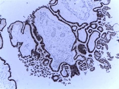 Borderline Ovarian Serous Tumor Pax8 Diffuse Positive In Tumor Cells