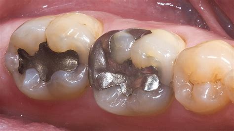 Dental Amalgam Filling Replacement