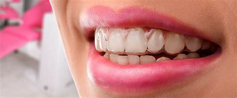 Invisalign Nevidni Zobni Aparati Zoboestetika D O O