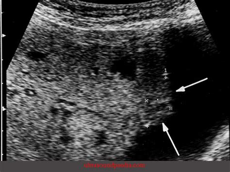 Placenta accreta – ULTRASOUNDPAEDIA