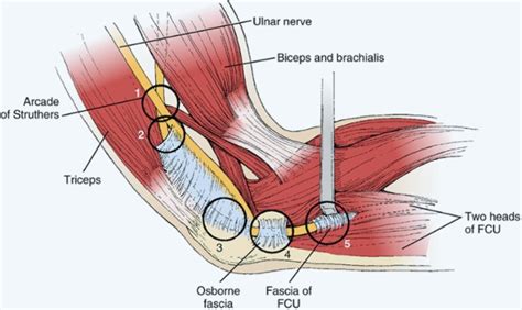 Ulnar Nerve Entrapment Cubital Tunnel Syndrome Porn Sex Picture