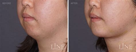 Gallery - Chin Implant - Line Plastic Surgery Center