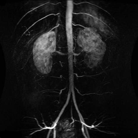 Magnetic Resonance Angiography MEDizzy