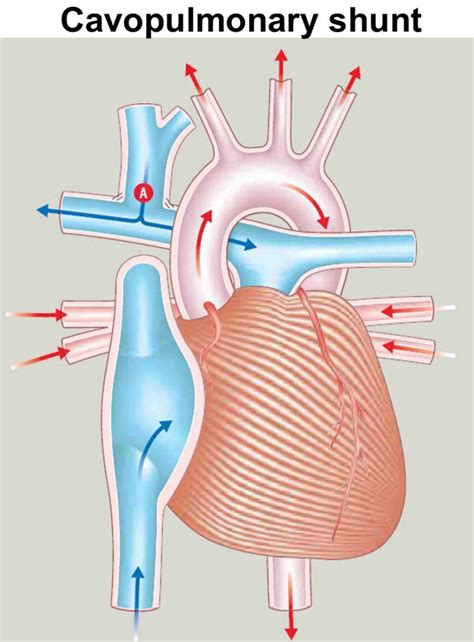 Tricuspid atresia causes, symptoms, diagnosis, treatment & prognosis