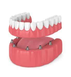 What Are Implant Overdentures And Are They Right For Me Sarasota