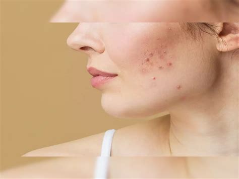 How To Remove Pimple Marks Acne Scars Turmeric Coconut Oil Lemon Aloe