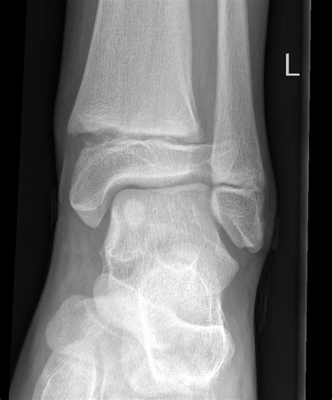 Radiopaedia Case Physeal Fracture Distal Tibial Salter Harris I Id