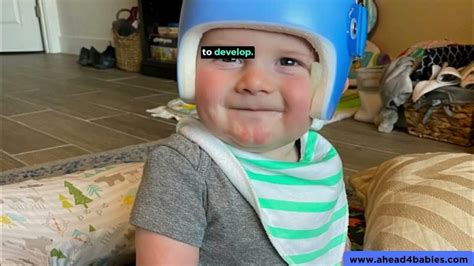 Plagiocephaly Helmet Therapy Flat Head Infant Treatment Uk Youtube