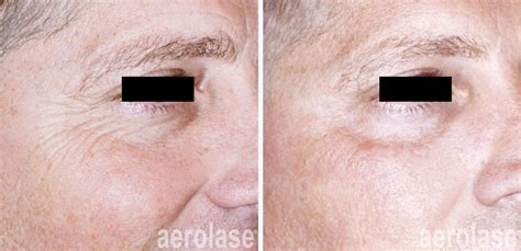 Aging Skin Before and After Gallery • Aerolase