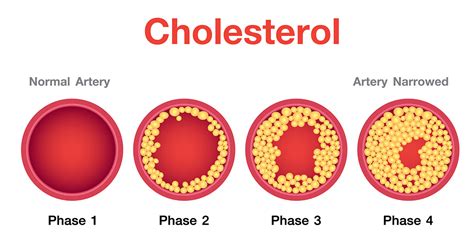 What Is High Cholesterol Chandigarh Ayurved Panchakarma Centre