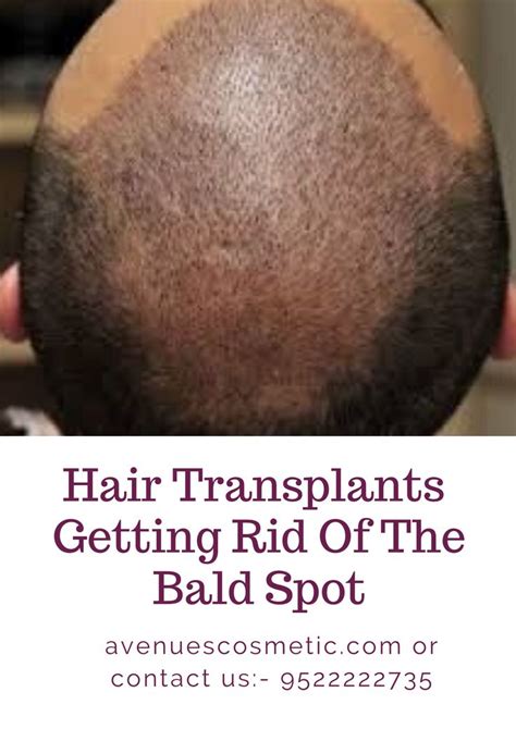 Hair Transplants Getting Rid Of The Bald Spot Hair Transplant Best