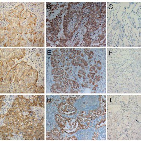 The expressions of OPN αvβ3 and Pim 1 in NSCLCs and adjacent normal