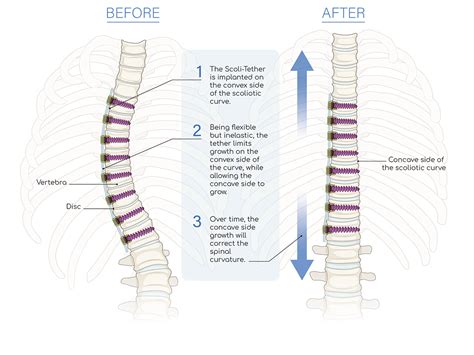 Concave Vs Convex Scoliosis