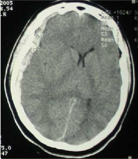 Acute Subdural Hematoma In The Right Frontoparietal Region Which Is