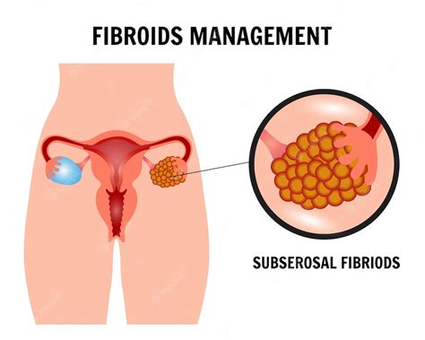 Premium Vector Infographic Or Female Fibroids Management In Vector