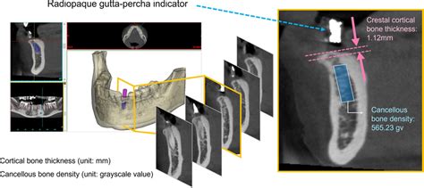 The Measurement Of Cancellous Bone Density And Cortical Bone Thickness