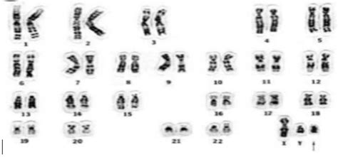 El siguiente cariotipo corresponde a A Mujer afectada por Síndrome
