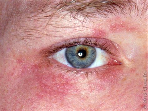 Periocular Dermatitis Around Eyes