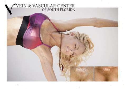 Vein Vascular Center Of South Florida Updated December