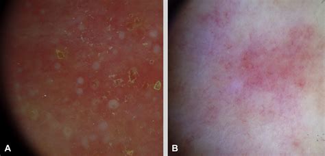 Dermoscopy As An Auxiliary Tool In The Early Differential Diagnosis Of