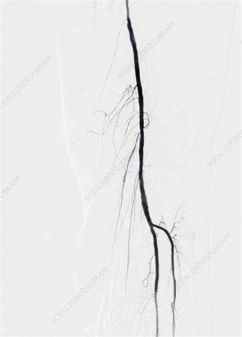 Femoral artery, CT scan - Stock Image - F037/7154 - Science Photo Library