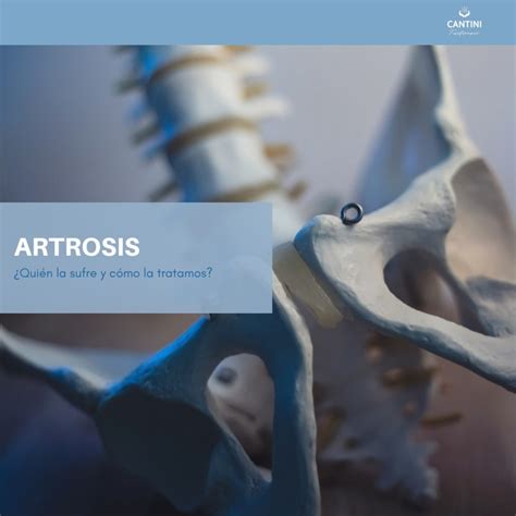 ARTROSIS CANTINI FISIOTERAPIA OSTEOPATÍA