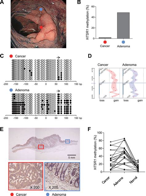 Alteration Of NTSR1 Methylation During The Progression Of Colorectal