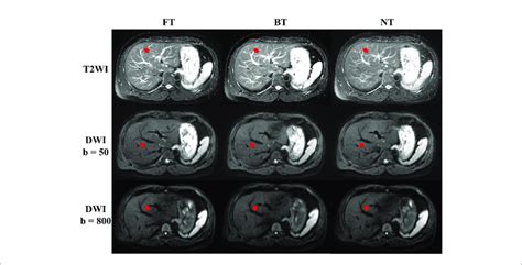 Example Abdominal T2 Weighted Imaging T2wi And Diffusion Weighted