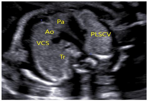 Jcm Free Full Text Persistent Left Superior Vena Cava Significance In Prenatal Diagnosis