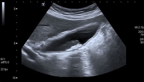 Gallbladder Ultrasound Scans Object Detection Dataset By Pocus