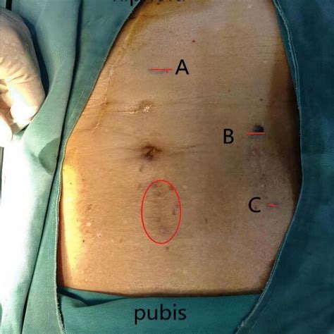 Hernia Location And Port Position The Circle Depicts The Hernia A