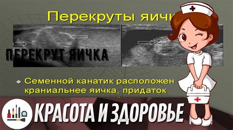 Перекрут яичка - YouTube