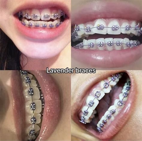 Pin Iamsunny00 Braces Colors Cute Braces Cute Braces Colors