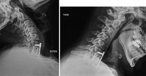 Anterior Cervical Approach Decompression And Fusion With Cages