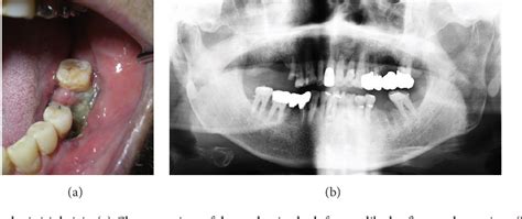 Figure 1 From Rapidly Progressing Osteomyelitis Of The Mandible