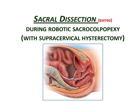 Sacral Dissection Edited During Robotic Sacrocolpopexy Plus