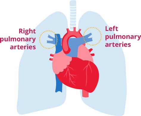 What Is Pulmonary Arterial Hypertension Unmask Pah