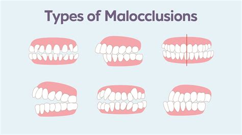 What Is Malocclusion How To Treatment Malocclusion