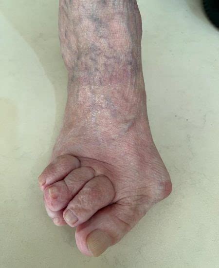 Cirurgia Para Joanete Hallux Valgus