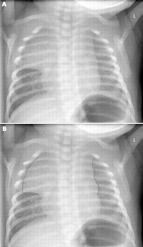 The Normal Thymus And How To Recognise It Adc Education Practice