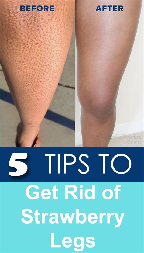 Strawberry Legs 5 Ultimate Tips To Get Rid Of It Getinfopedia Strawberry Legs Clear Skin