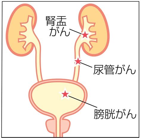 膀胱がんのイラスト 膀胱がんの検査と治療は？ 尿道から内視鏡入れ検査、切除も【ドクターに聞く】 写真・画像22｜【西日本新聞me】