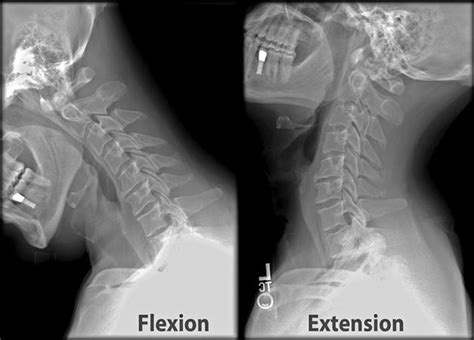 Cervical Spine Trauma Evaluation - Spine - Orthobullets