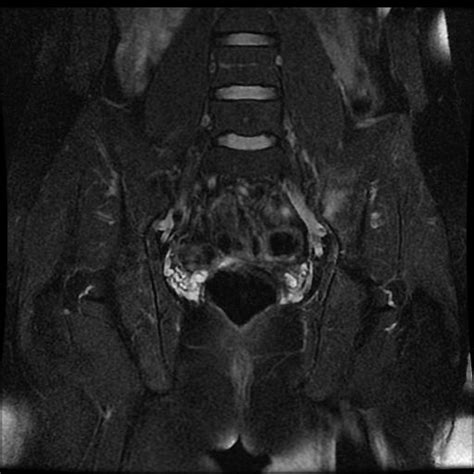 Acute Sacroiliitis Unilateral Image