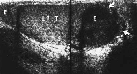 Tuberculous Epididymitis And Epididymo Orchitis Sonographic Appearances